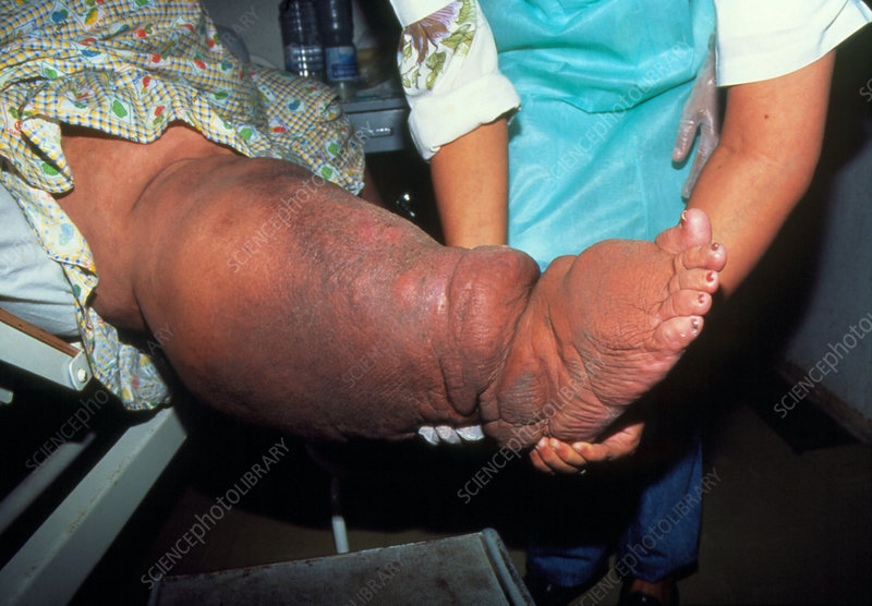 M1600030-Swollen_right_leg_of_elephantiasis_patient-SPL.jpg
