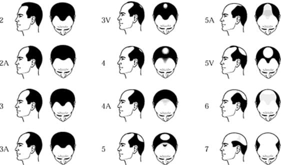 male-pattern-baldness-chart.jpg